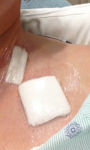 Two incisions for one port. Yay no more needle sticks!